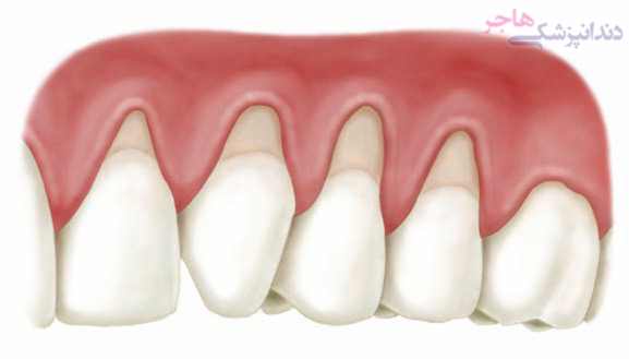 Gum recession